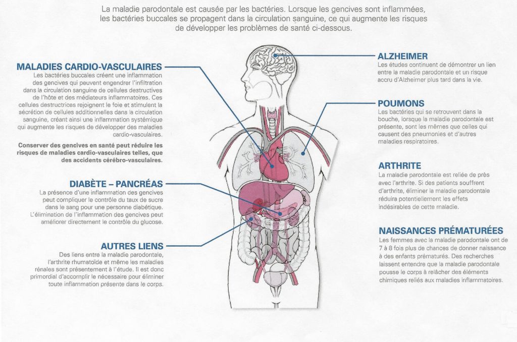 Parodontite effets sur la santé 